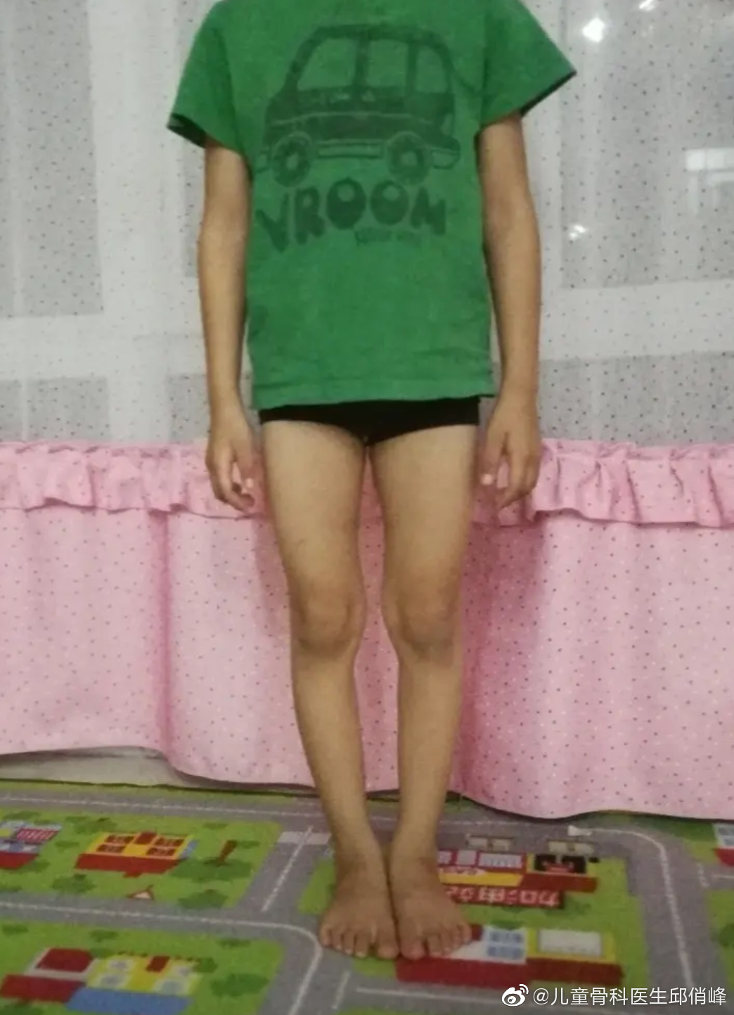 小孩腿不直捆腿有用吗