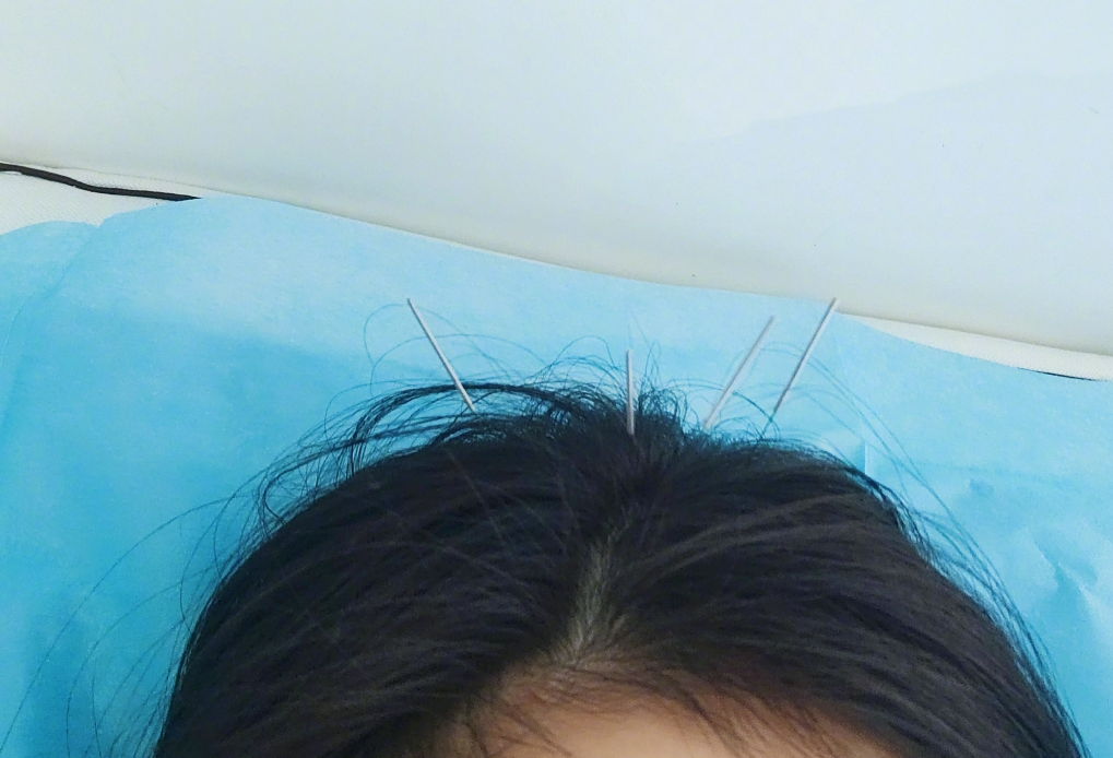 杨幂晒扎针灸照,一头银针蛮吓人,却被朋友调侃是"信号增强狐"