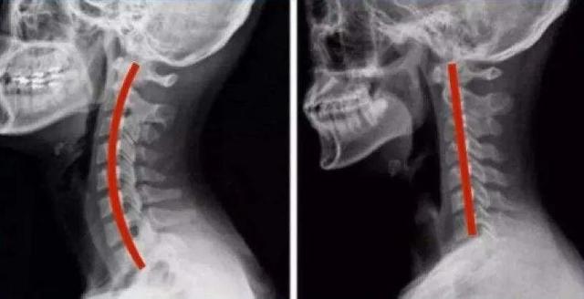 有种病态叫颈椎太“直”了!一个矿泉水瓶改善颈部曲度休闲区蓝鸢梦想 - Www.slyday.coM 有种病态叫颈椎太“直”了!一个矿泉水瓶改善颈部曲度休闲区蓝鸢梦想 - Www.slyday.coM