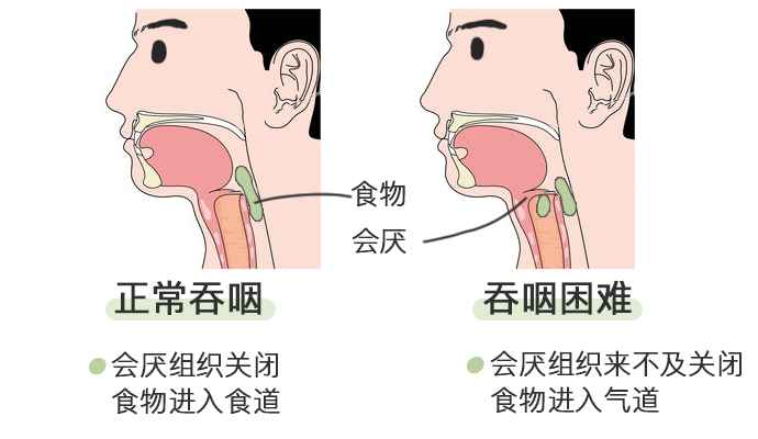 正常吞咽时:会厌则向下,盖住气管,食物或水不会进入气管;●呼吸说话