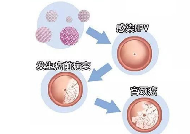 宫颈癌的慷概自白书我是怎样练成的