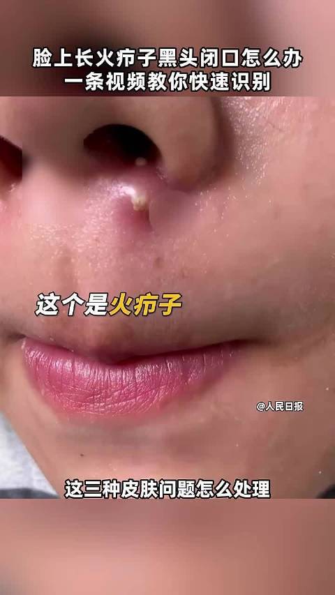 脸上长火疖子黑头闭口怎么办?一条视频教你快速识别 点击关注_新浪新闻