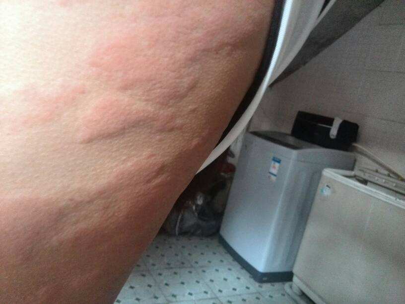 过敏湿疹该怎么治疗呢