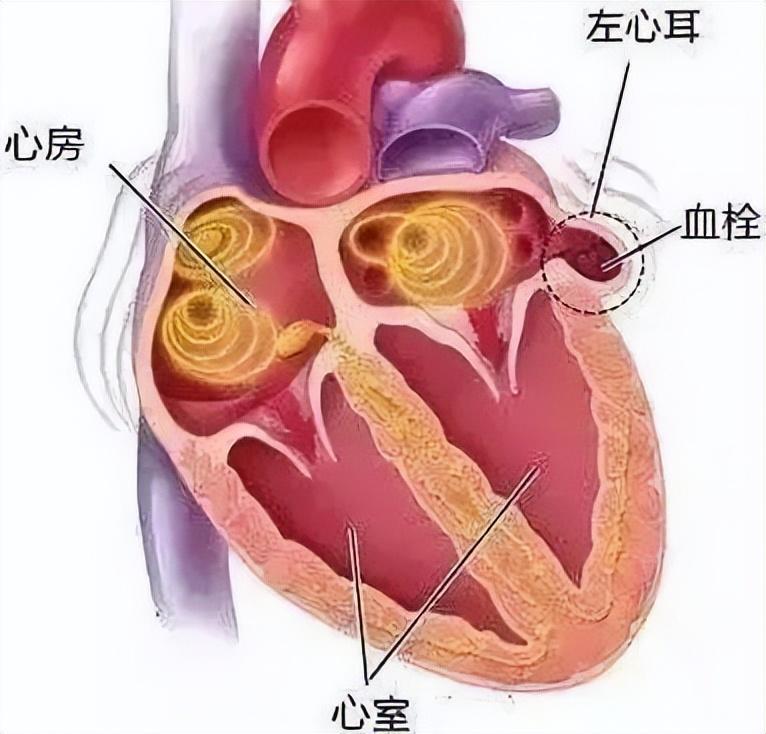 河南首例"二尖瓣瓣中瓣置换 左心耳封堵一站式手术"在河南省胸科