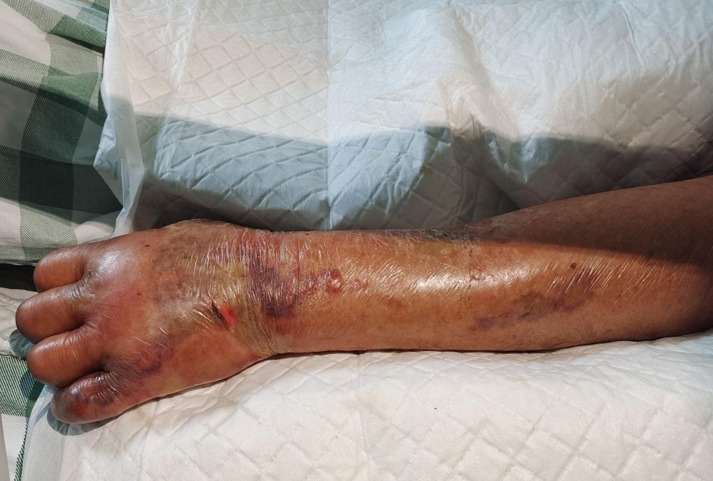 八旬老人洗虾手指被刺，竟得切除左上肢来保命！休闲区蓝鸢梦想 - Www.slyday.coM