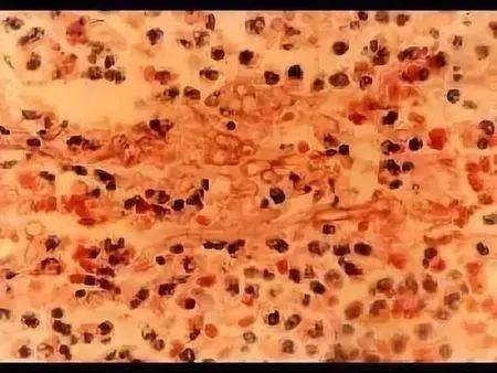 在细菌产生的透明质酸酶,肝素酶的作用下,导致小血管内血栓形成,影响