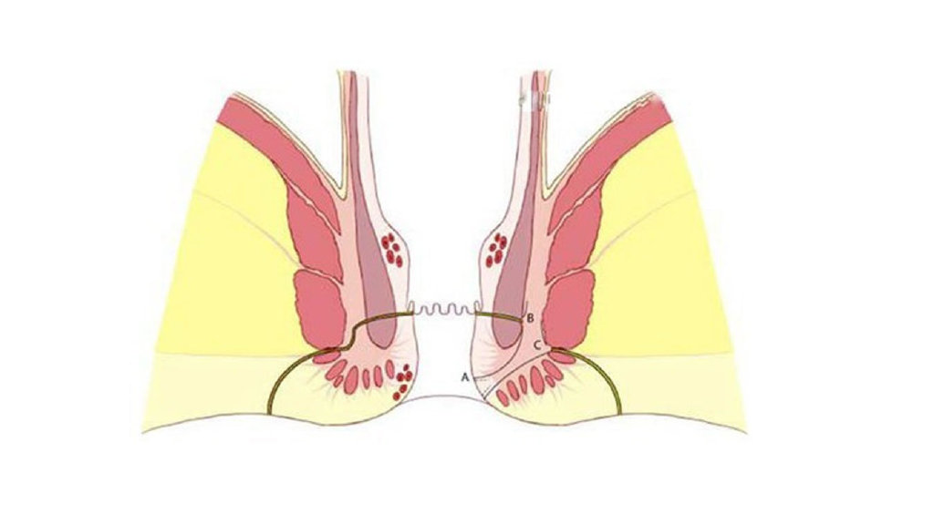 各种原因导致细菌从肛门内的黏膜薄弱或破损处侵入(一般是肛隐窝处)