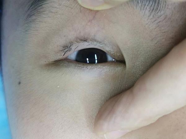 男孩剪掉倒睫毛以方便医生做手术,岂料好心办坏事|睫毛|做手术|剪掉