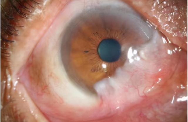 爹爹的结膜上长出了红色的"肉",到医院检查才知道是假性翼状胬肉