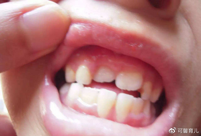 孩子乳牙脱落关键期父母一定关注几个要点协助孩子顺利换牙