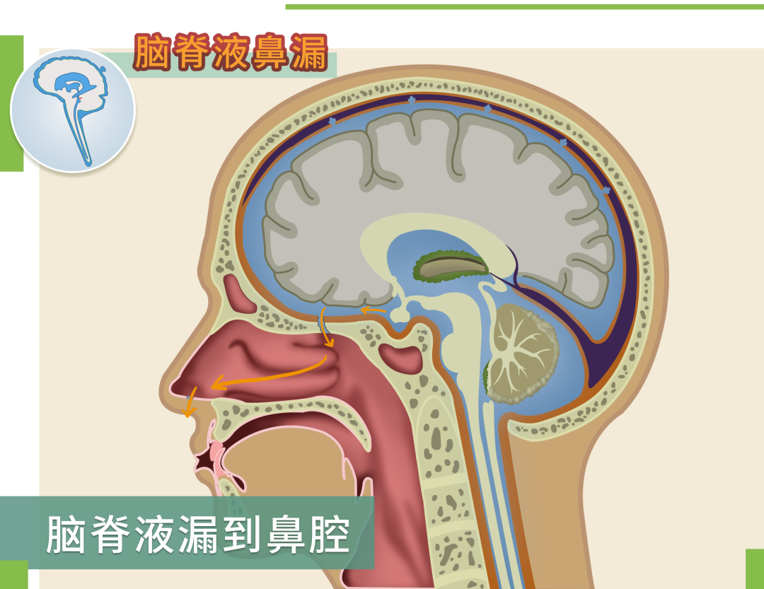 并在压力的作用下,比如咳嗽,用力排便等增加颅压的情况下,脑脊液