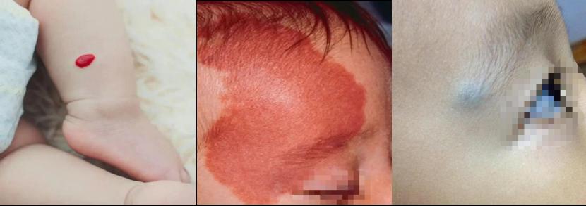血管瘤与胎记，傻傻分不清？一文教您正确识别与就医