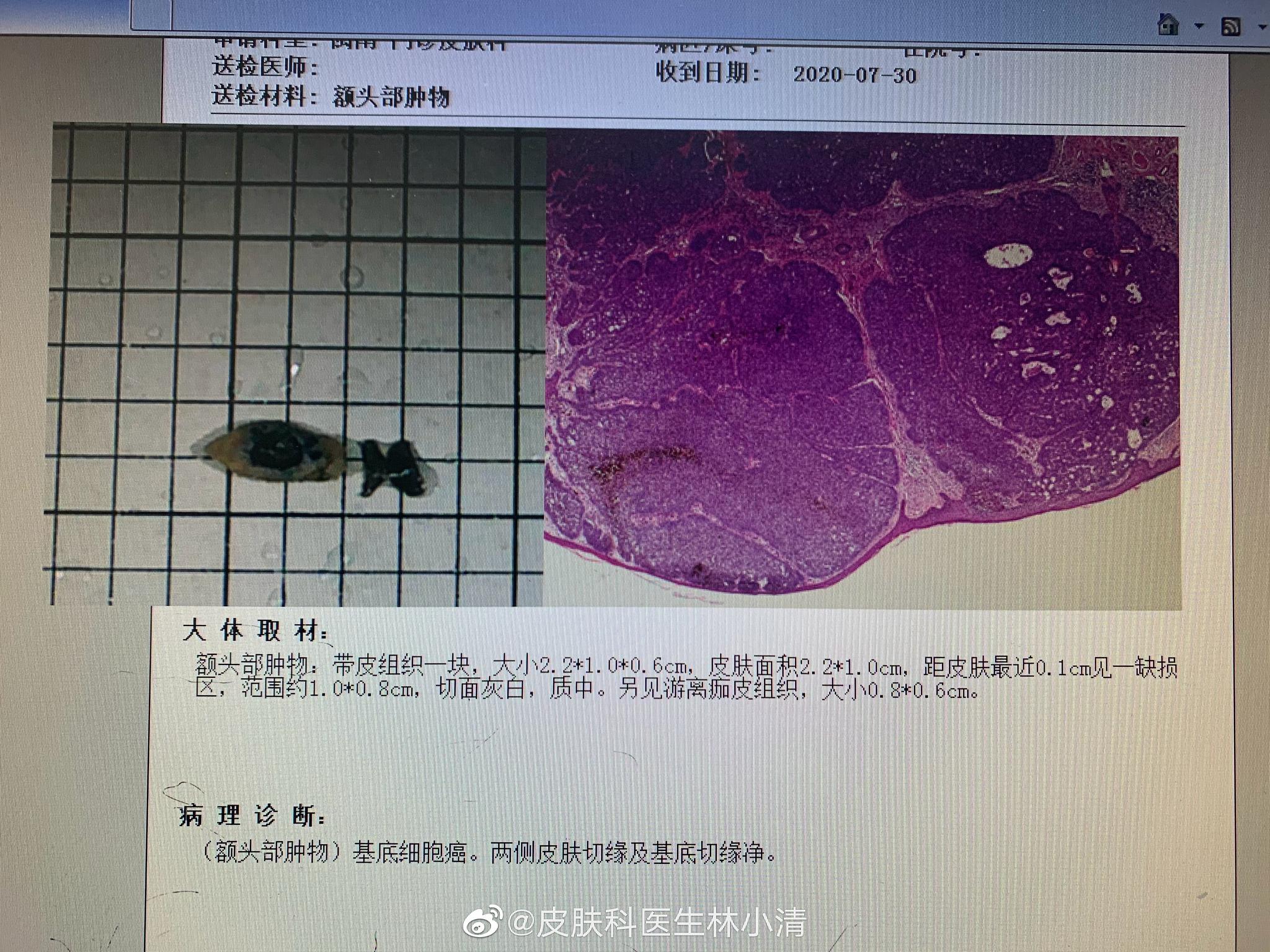 十几年的基底细胞癌了 过来的时候老人家一直不想手术 作为医生