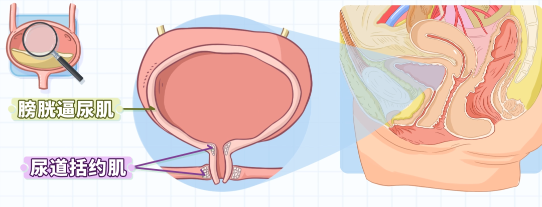 例如,有的尿道括约肌敏感性增加,到了后期可能会抑制膀胱收缩,导致尿