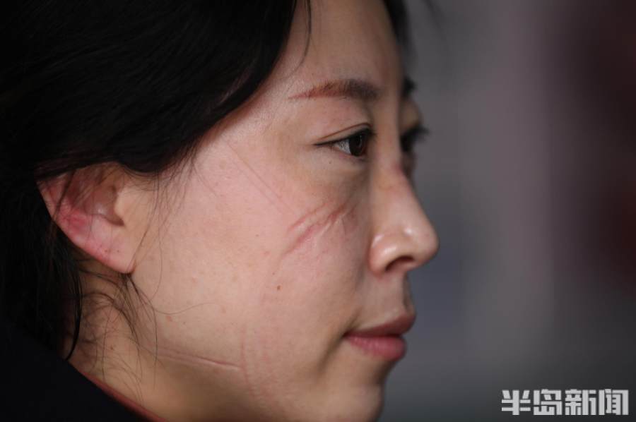 摘下面罩,脸上清晰可见口罩勒痕.中午吃饭,就在路边台阶解决.