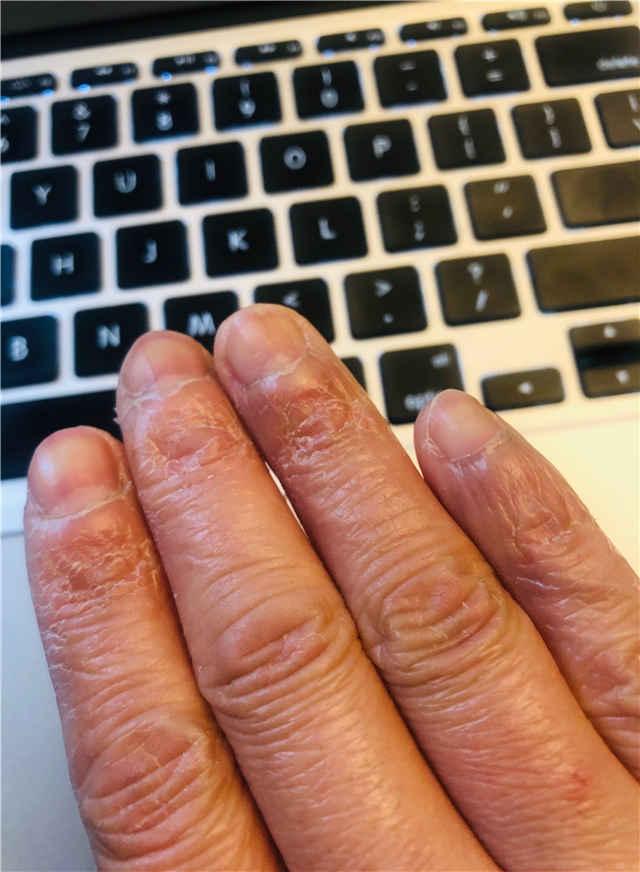 这是一双红肿,粗糙的手,每根手指上都布满了翘起的死皮.