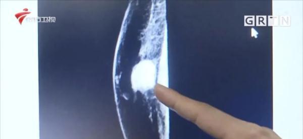 五旬男子胸部发育，竟是乳腺癌休闲区蓝鸢梦想 - Www.slyday.coM