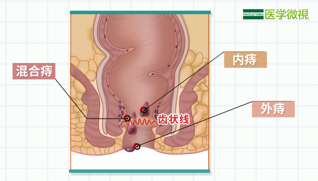 痔疮|内痔|静脉曲张_新浪新闻