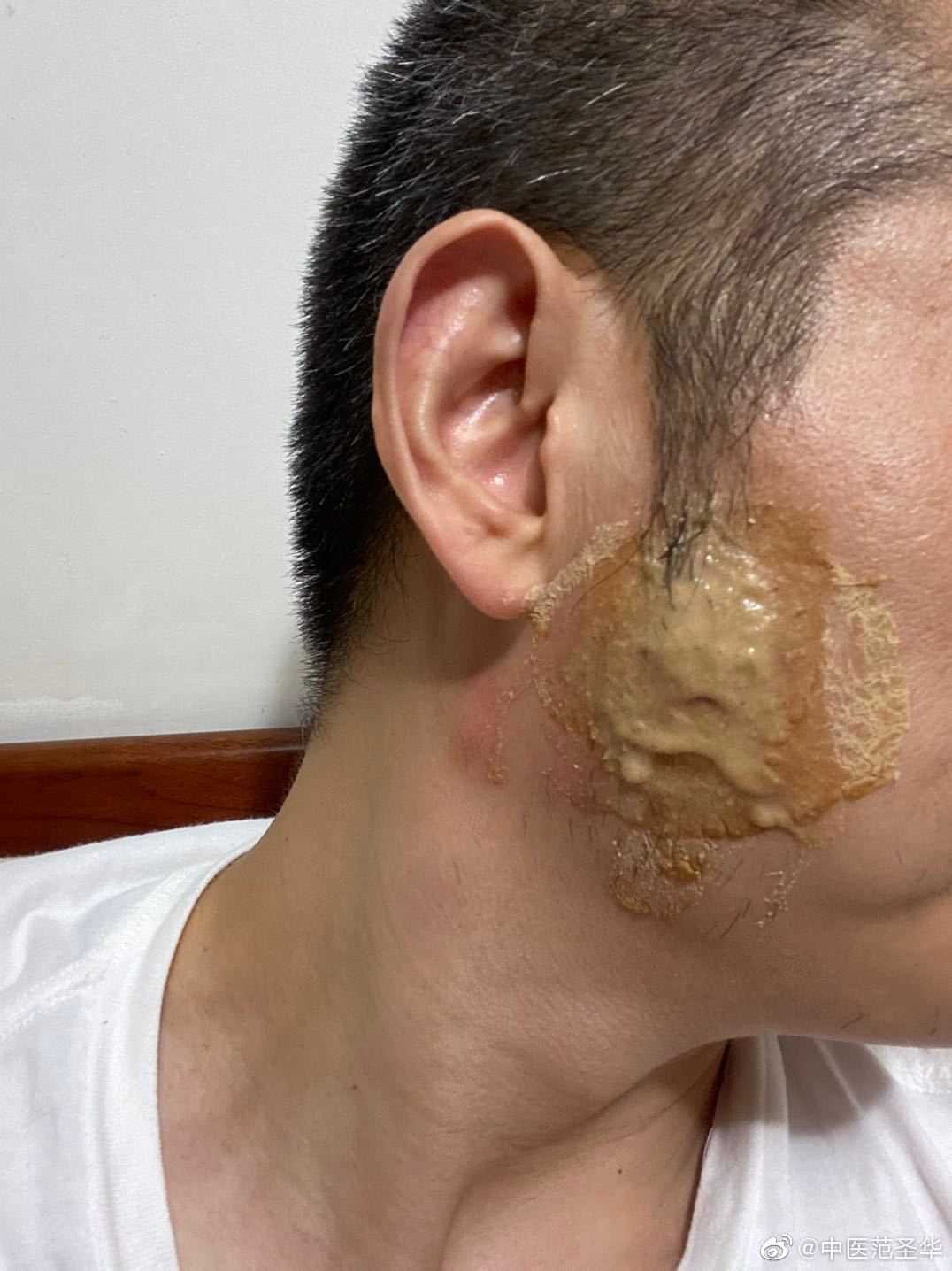 1 / 3 一患者,得了腮腺炎后留下较大的结节.让患者每天喝海带汤治疗.