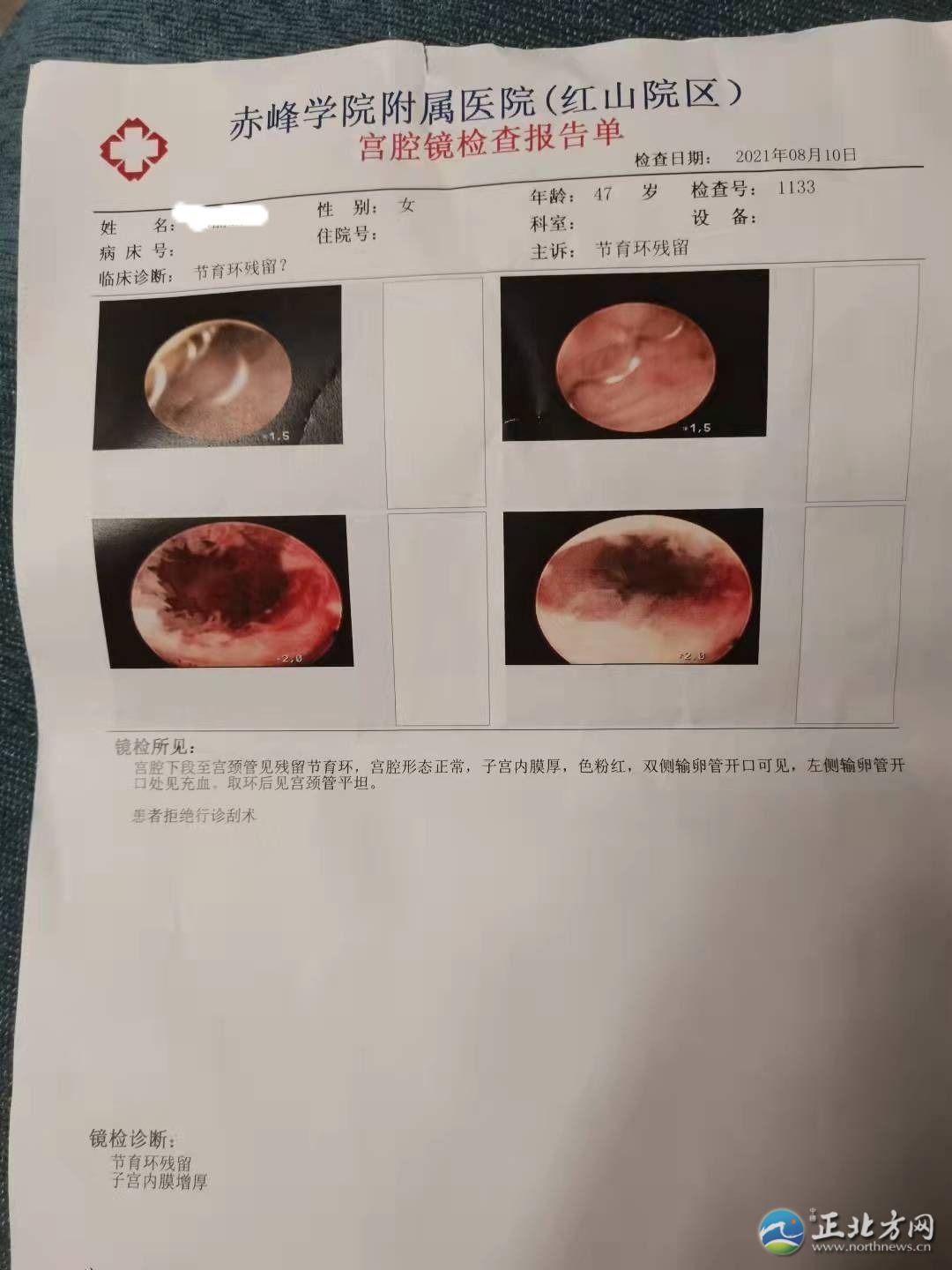 赤峰学院附属医院宫腔镜检查报告单赤峰学院附属医院诊断书赤峰学院