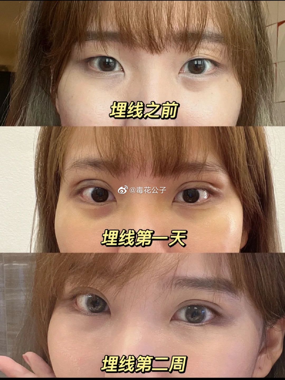 埋线双眼皮也这么96吗?_高清图集_新浪网