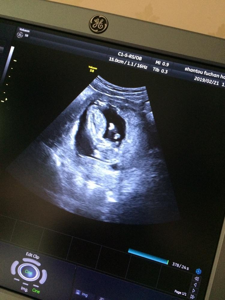 怀孕11周女孩彩超图图片