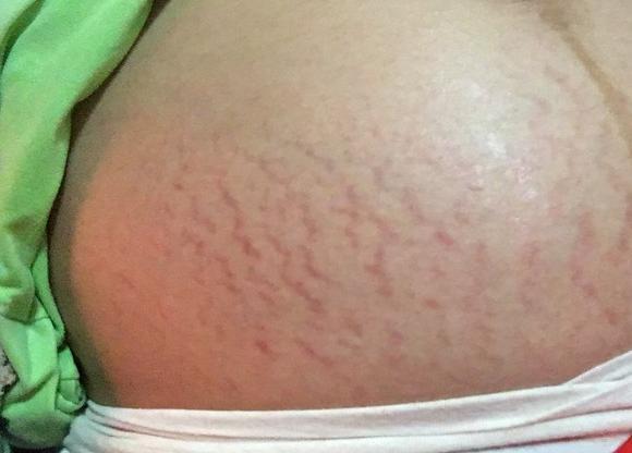 同样是怀孕当妈为何有些孕妈不长妊娠纹主要和孕妇的妈妈有关