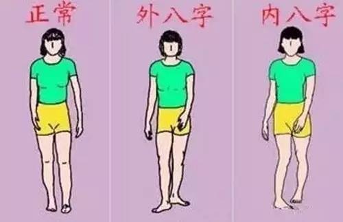 走路时"内八字"宝宝走路时两脚朝内,就像螃蟹的大夹子.