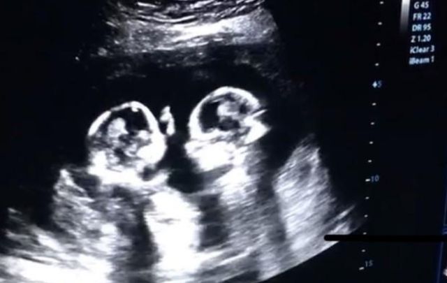 双胞胎在宝妈肚子里打架,镜头拍下全过程,看完不许笑休闲区蓝鸢梦想 - Www.slyday.coM