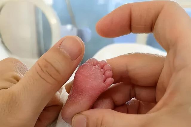 出生时仅有700克陕西一手掌大的宝宝出院了