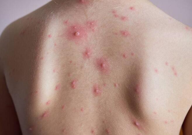 得了糖尿病,皮肤也"受罪"!警惕:会诱发这7种皮肤疾病