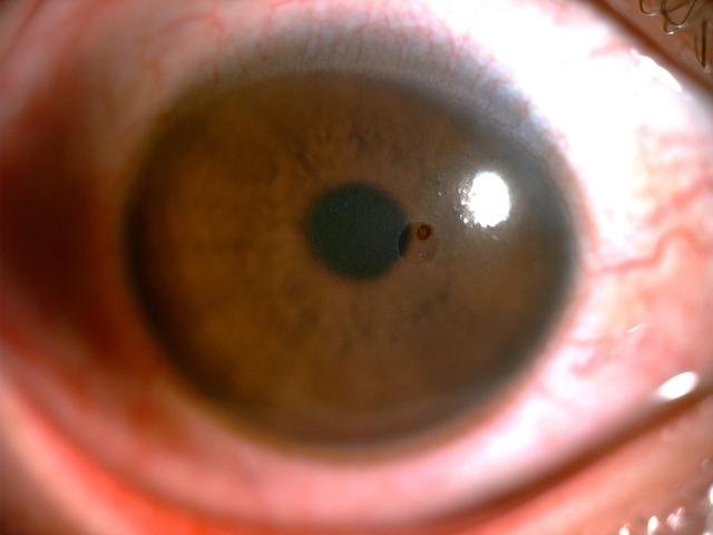 胡先生的角膜出现擦伤,角膜上皮有部分脱落,更让人惊讶的是竟然在胡