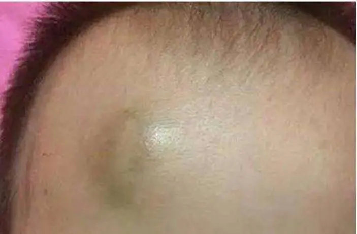 这个"包"是摔伤后细小血管的破裂出血,为头皮血肿,一般几天内就会自行
