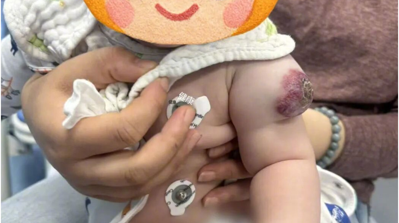 跨越山海的信任：外籍宝宝血管瘤治愈之路