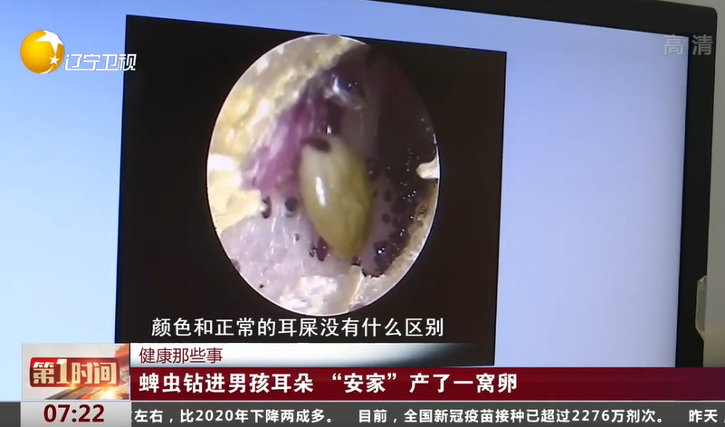 蜱虫钻进男孩耳朵,"安家"又产卵:虫子入耳,我们可以这样做