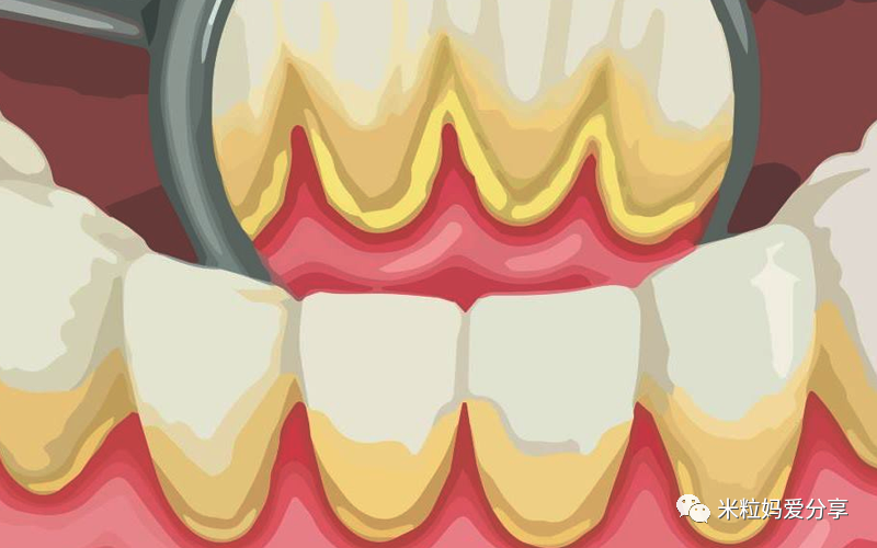 天天刷牙居然满嘴都是牙结石