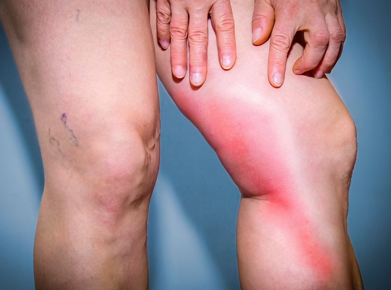 尿酸高的人身体有3个表现希望你一个都不占