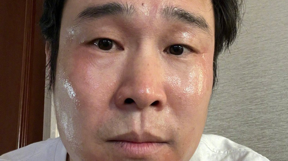 小沈阳确诊新冠,过敏满脸通红,自嘲是“敏阳阳”,既好笑又心疼|阳性|退烧贴|张兰_新浪新闻