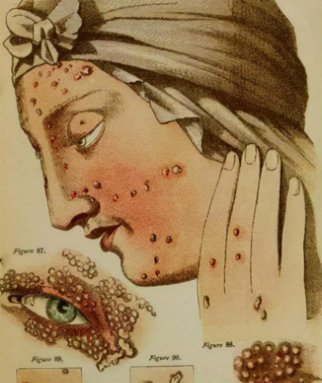 恶魔病毒蠢蠢欲动曾杀死5亿人的天花一旦泛滥能否把人类灭绝