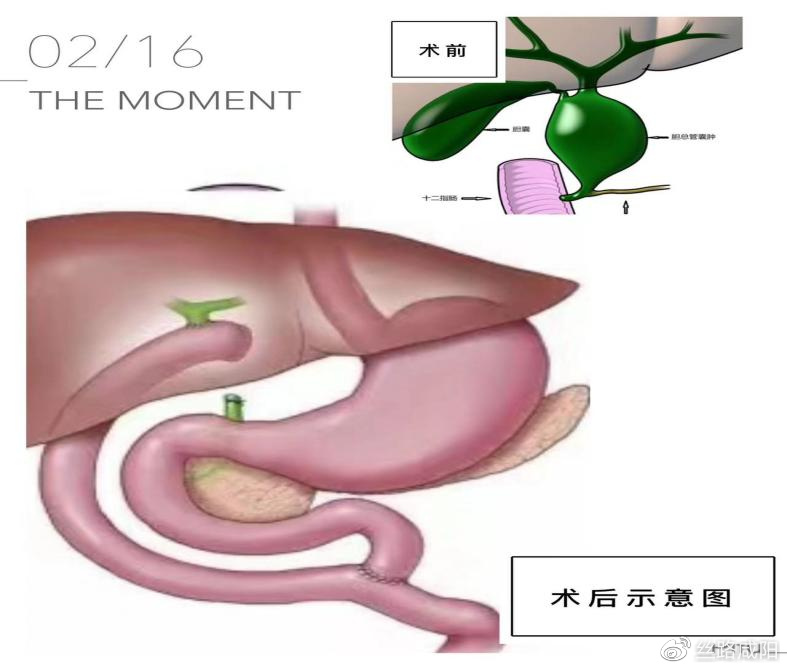 咸阳彩虹医院宝宝腹痛要警惕先天性胆总管囊肿