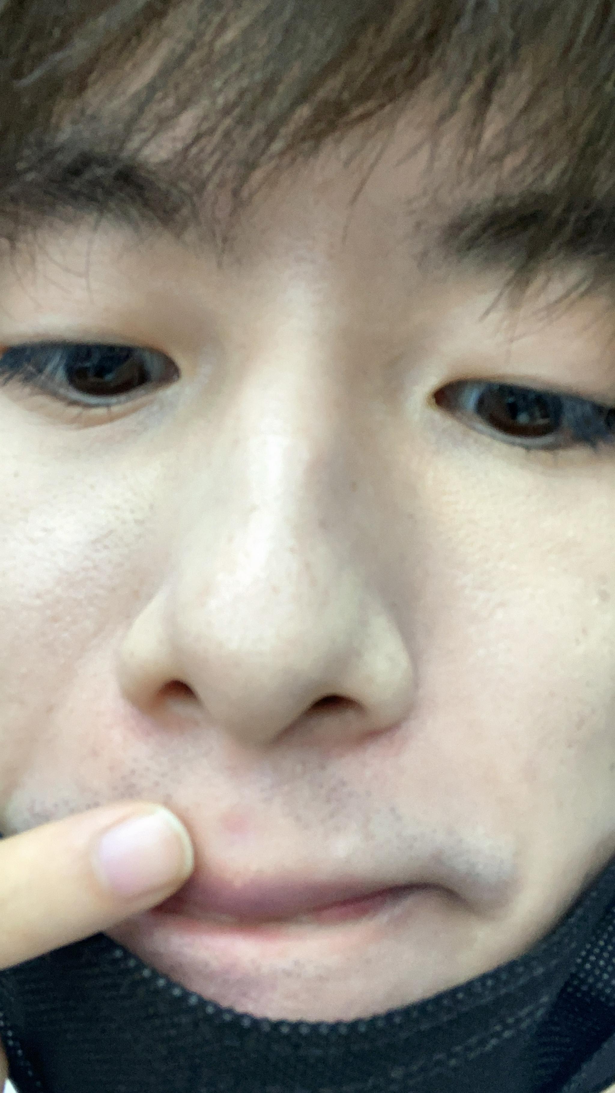 人中长了个痘痘怎么办,嘴唇都肿起来了,又还没熟不能挤……__财经头条