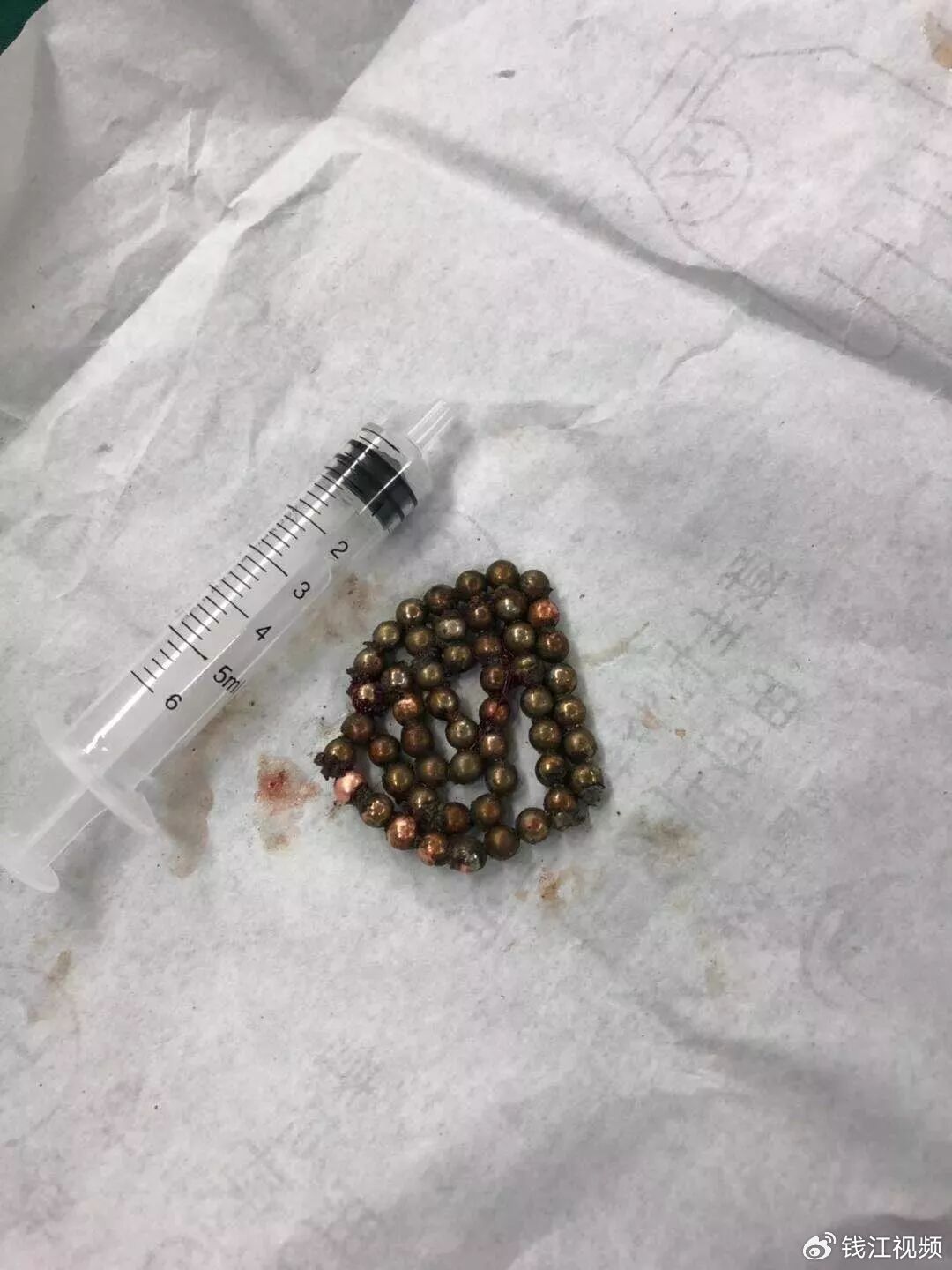 只有想不到,没有进不去的!泌尿外科医生盘点那些塞进身体里的……|异物|陈佳楠|异物危害|尿道异物|浙江省_新浪新闻