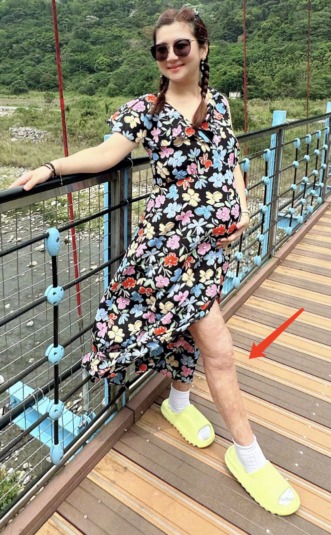 selina和男友出游,挺孕肚过母亲节,大方晒出双腿烧伤