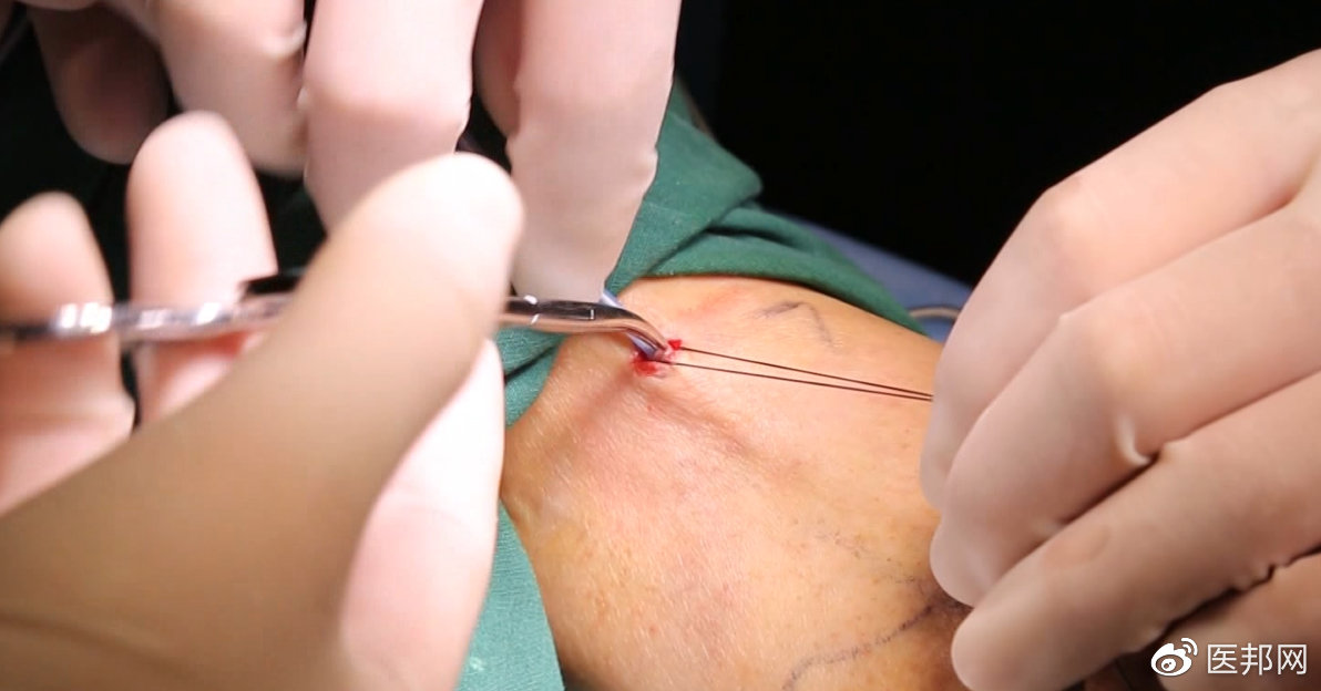 可以治愈静脉曲张的唯一方法,也有微创了,最佳治疗时机别错过休闲区蓝鸢梦想 - Www.slyday.coM 可以治愈静脉曲张的唯一方法,也有微创了,最佳治疗时机别错过休闲区蓝鸢梦想 - Www.slyday.coM