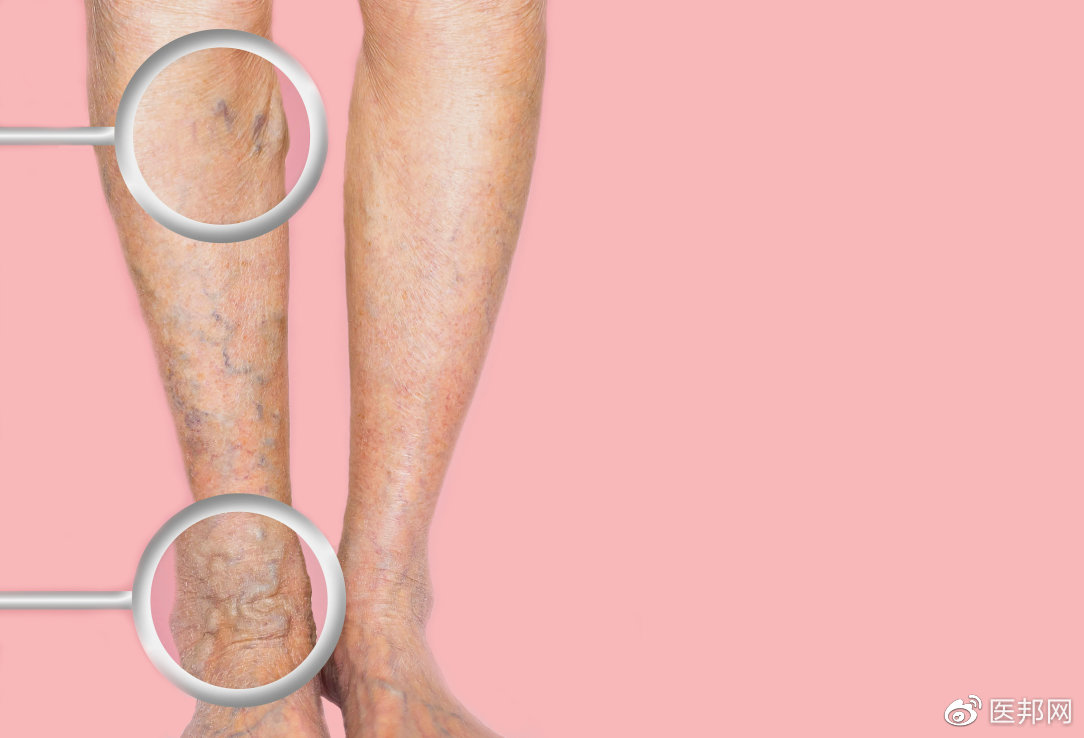 可以治愈静脉曲张的唯一方法,也有微创了,最佳治疗时机别错过休闲区蓝鸢梦想 - Www.slyday.coM 可以治愈静脉曲张的唯一方法,也有微创了,最佳治疗时机别错过休闲区蓝鸢梦想 - Www.slyday.coM