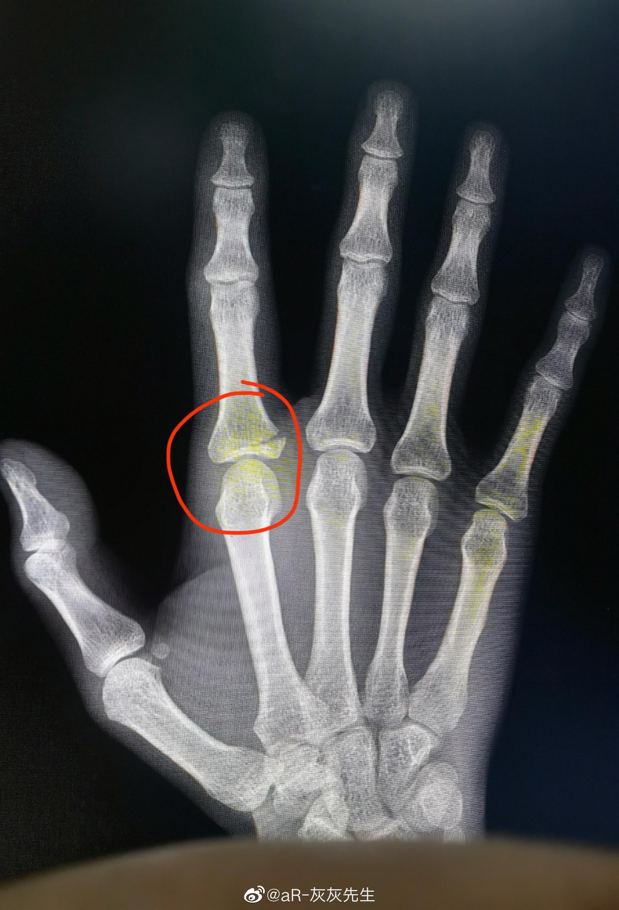 以为没啥事的,结果拍片是骨折_高清图集_新浪网