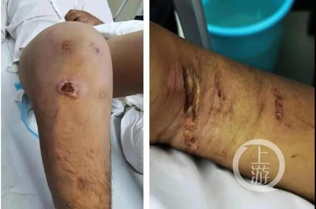 今年5月25日,张吴被救出时,全身多处受伤 上游新闻