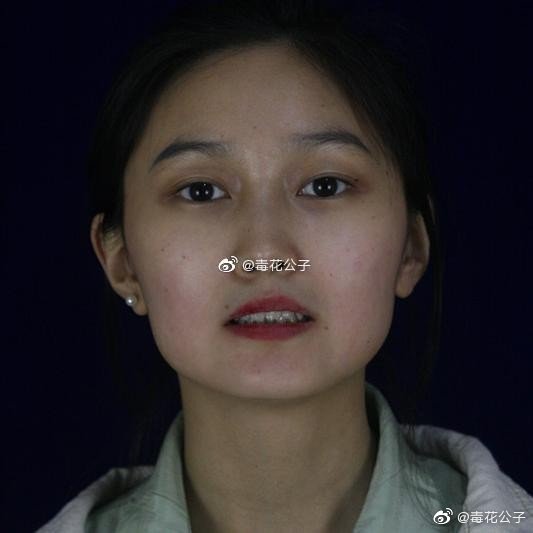 以前下颌角宽大,脸是很不好看的方脸