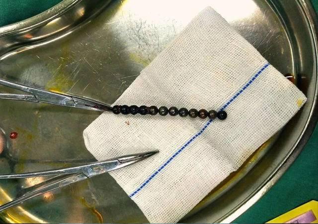 磁力珠被孩子误食后会发生什么?答:有可能肠道会"乱套"