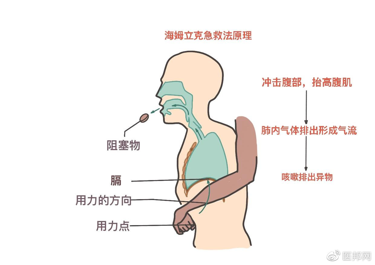 关键时刻能救命针对不同人群的海姆立克急救方法超详细图解